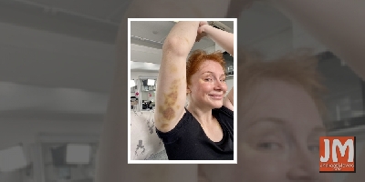 Bryce Dallas Howard shows off her 'Jurassic World' bruises